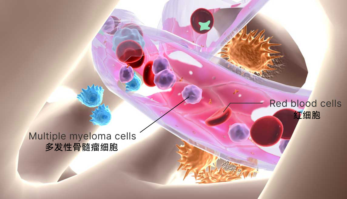 Multiple-Myeloma.jpg